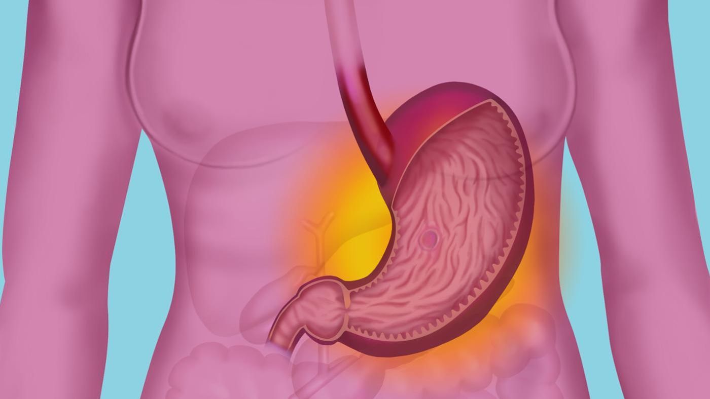 МАЛЬТ-лимфома желудка: симптомы и лечение мальтомы
