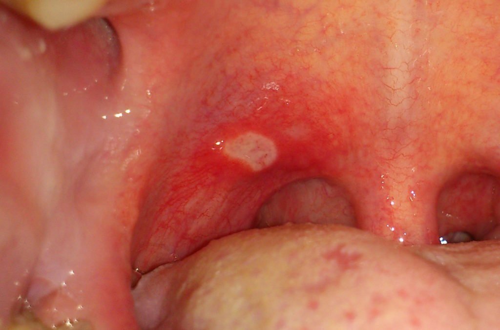 Стоматит на миндалинах у взрослых и ребенка (ФОТО): может ли быть и чем ...