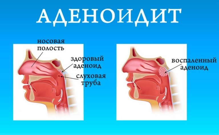 Где находятся гланды у человека на шее показать на рисунке