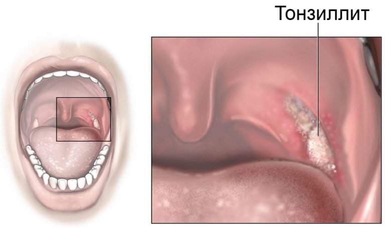 Где находятся гланды у человека как выглядят здоровые