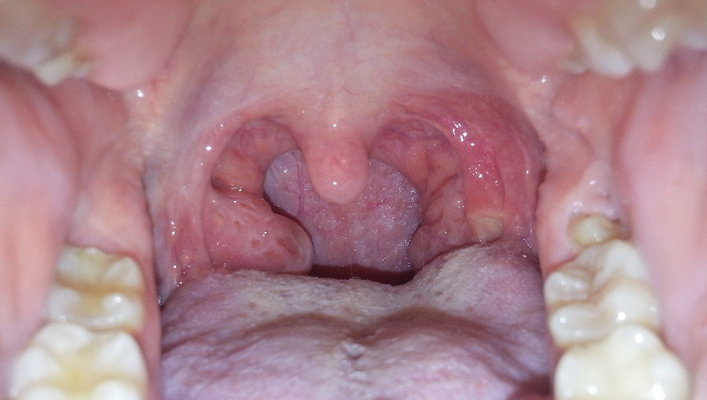 Болят миндалины в горле: что делать и чем лечить боль в гландах с одной ...