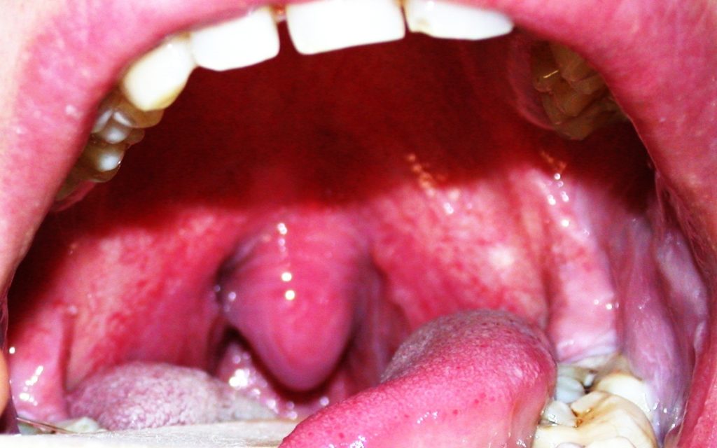 Наиболее частые причины опухания язычка в горле
