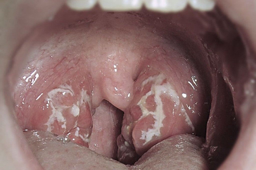 Воспаление миндалин в горле лечение народными средствами thumbnail