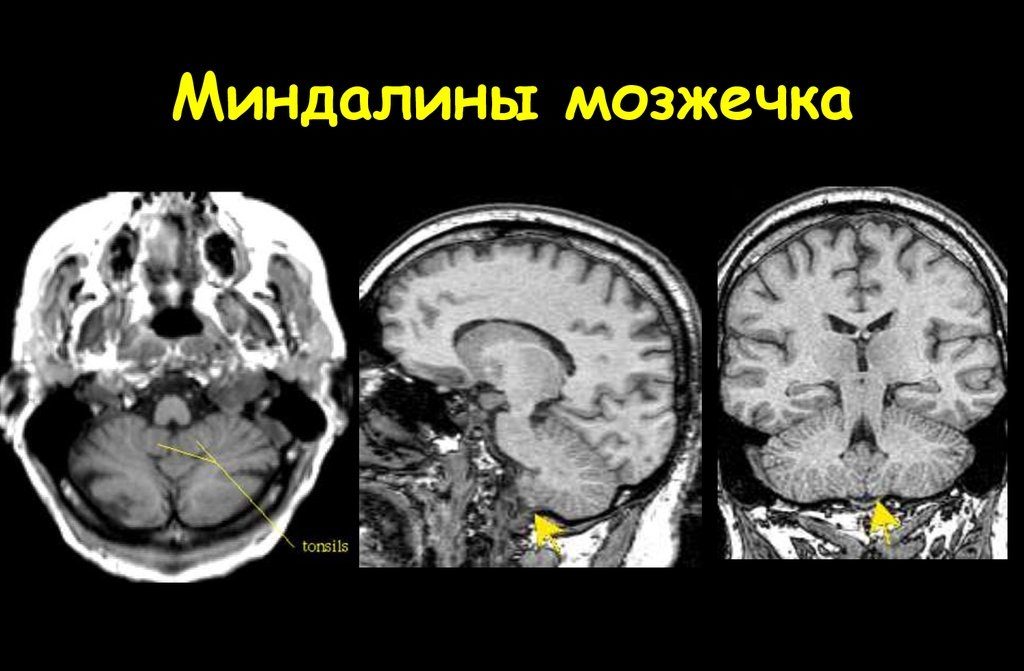 Расположение миндалин мозжечка