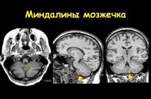 Мр картина нарушения статики