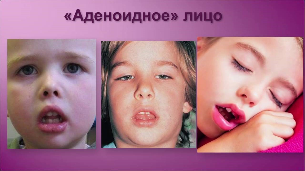 Что такое аденоиды у детей фото
