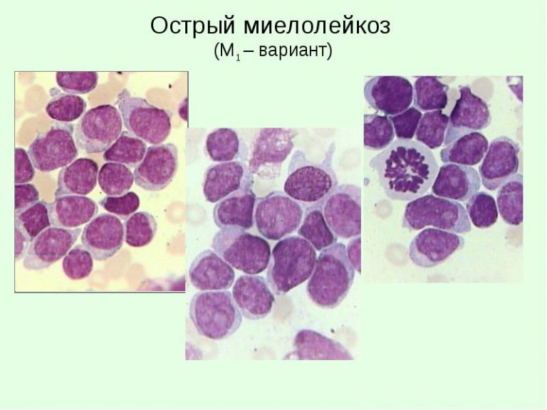 Жизнь после лечения лейкозов и лимфом книга