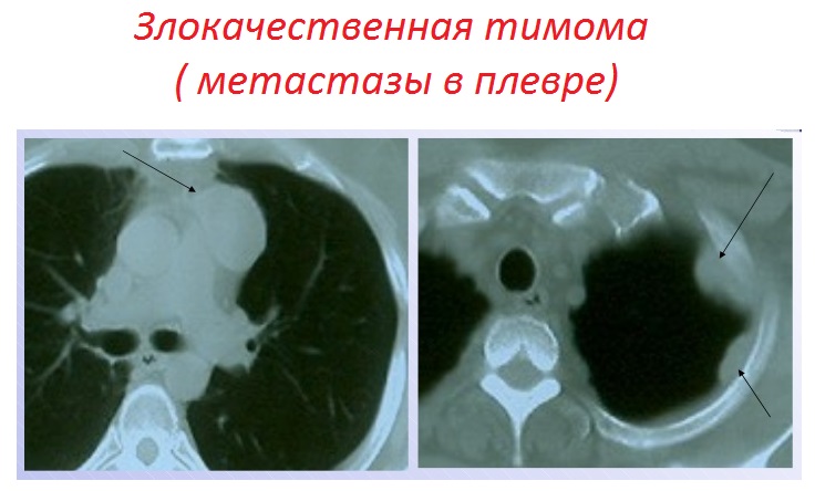 лечение тимомы