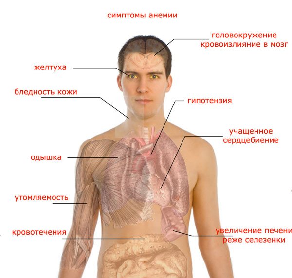 апластическая анемия симптомы у взрослых