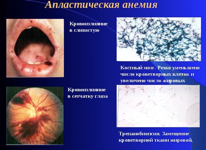 Картина крови при аллергии