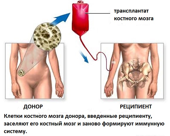 как происходит донорство костного мозга