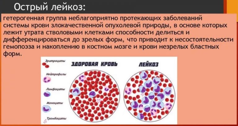 Эритробластный лейкоз картина крови