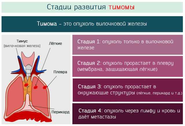 стадии развития тимомы