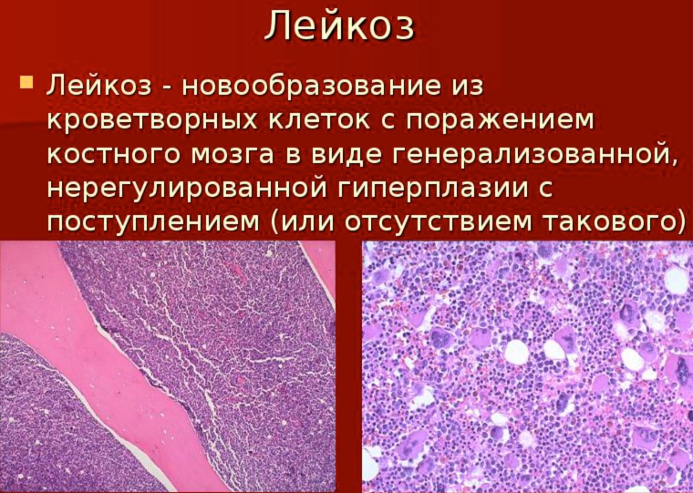 симптомы лейкоза у взрослых