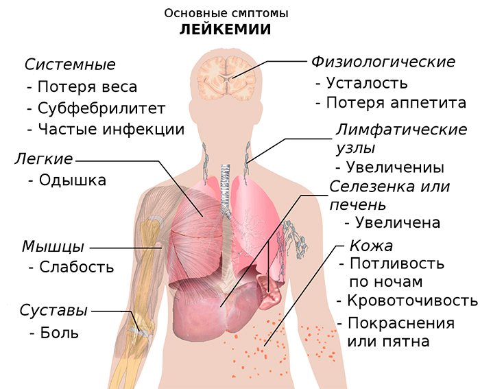 признаки лейкоза у взрослых